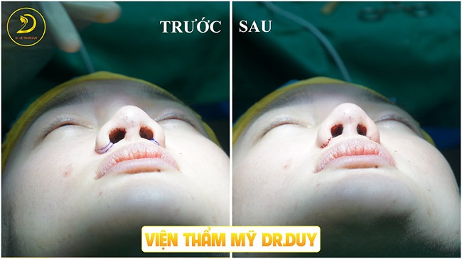 Trước và sau khi được bác sĩ Duy thu gọn cánh mũi