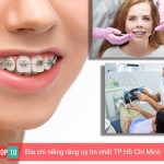 Top 10 địa chỉ niềng răng uy tín nhất TP. Hồ Chí Minh