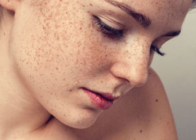 10 cách điều trị đồi mồi trên da mặt hiệu quả nhất