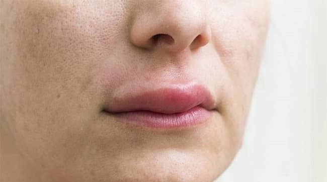 Phun môi bị mưng mủ Nguyên nhân và cách xử lý