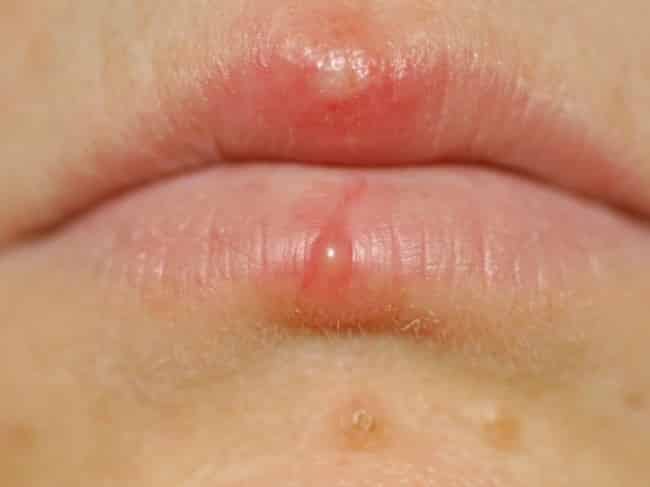 Nhận biết sớm dấu hiệu của phun môi bị nhiễm trùng  Nhà thuốc FPT Long Châu