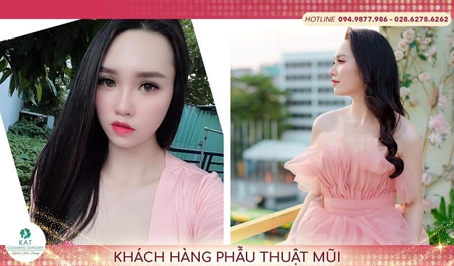 Khách hàng thu gọn cánh mũi tại Khoa Thảo