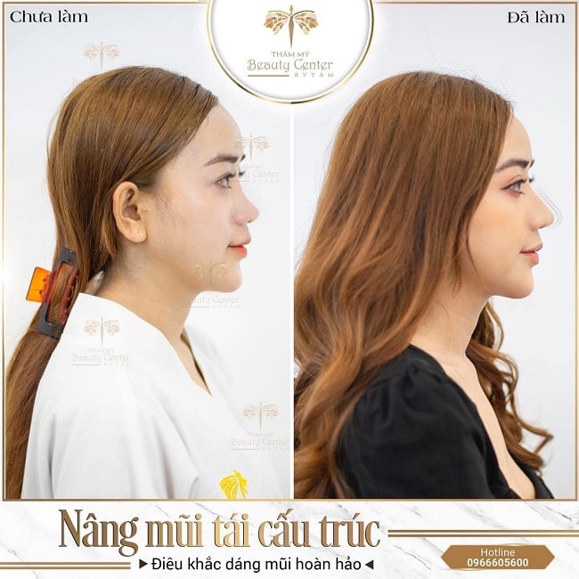 Nâng mũi Tấm 2