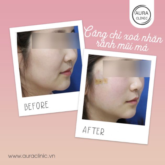 Căng chỉ xóa rảnh nhăn mũi và má tại Aura Beauty Clinic | Nguồn: Aura Beauty Clinic