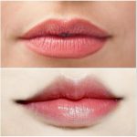Cắt môi trái tim ở đâu đẹp và uy tín ở TPHCM