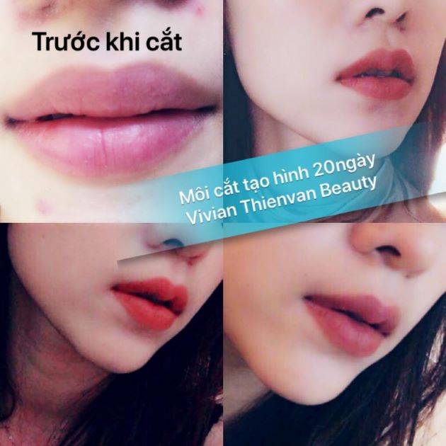 Cắt môi trái tim ở đâu đẹp và uy tín ở TPHCM - Vivian ThienVan Beauty  | Nguồn: Vivian ThienVan Beauty 
