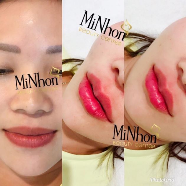 Cắt môi trái tim ở đâu đẹp và uy tín ở TPHCM - Minhon Beauty Center | Nguồn: Minhon Beauty Center