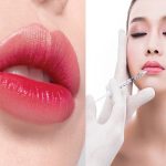 địa chỉ tiêm filler môi ở TPHCM