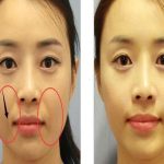 địa chỉ xoá rãnh cười ở TPHCM