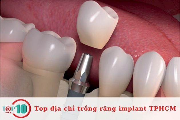 Địa chỉ trồng răng implant ở TPHCM uy tín| Nguồn: Nha khoa Peace Dentistry