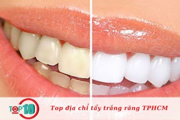 Địa chỉ tẩy trắng răng ở TPHCM| Nguồn: Nha Khoa Việt Nha