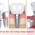 Top địa chỉ trồng răng implant tại TPHCM uy tín nhất