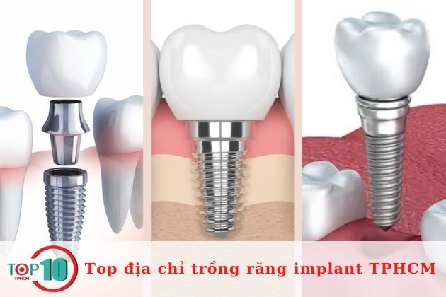 Top 10 địa chỉ trồng răng implant tại TPHCM uy tín nhất