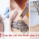 Top địa chỉ xóa hình xăm ở TPHCM tốt nhất