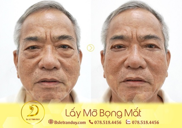 Lấy mỡ bọng mắt được thực hiện bởi Bác sĩ Lê Trần Duy