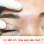 Top địa chỉ xóa xăm mí mắt ở TPHCM