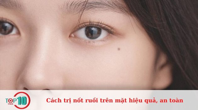 Các lưu ý khi trị nốt ruồi trên mặt tại nhà