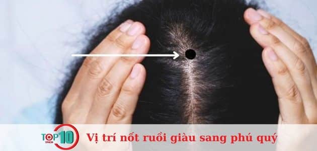 Nốt ruồi mọc trên đỉnh đầu