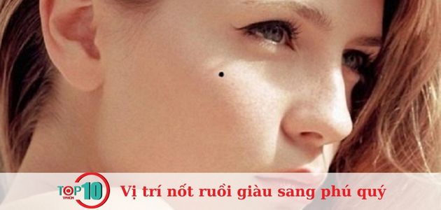 Nốt ruồi ở xương gò má