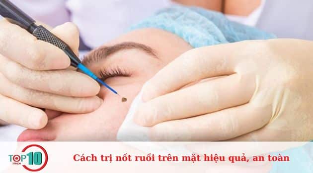 Tại sao phải trị nốt ruồi trên mặt?