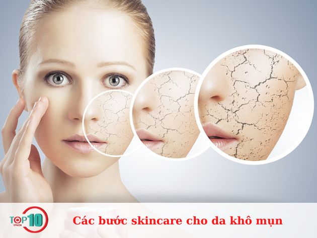 Các bước skincare cho da khô mụn hiệu quả