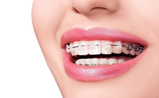 Giúp cho hàm răng của bạn đều và thu hút hơn bằng cách niềng răng
