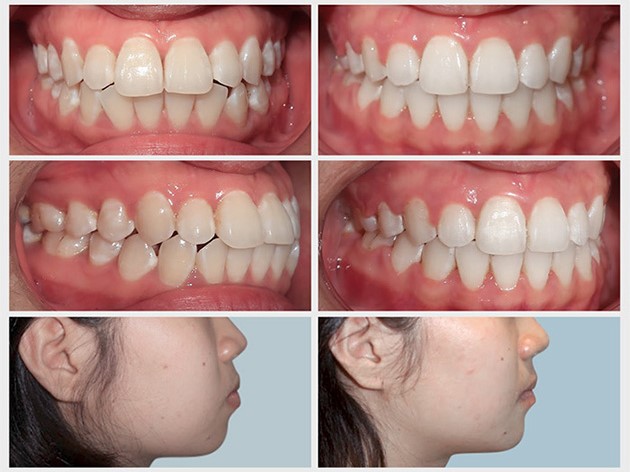 Hình ảnh thực tế của khách hàng trước và sau khi niềng răng
