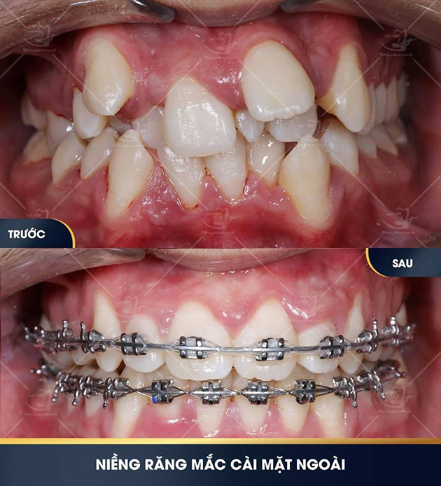 Hình ảnh trước và sau khi niềng răng thành công