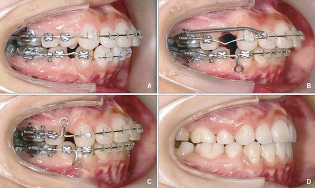 Hình ảnh các giai đoạn sau khi niềng răng một thời gian