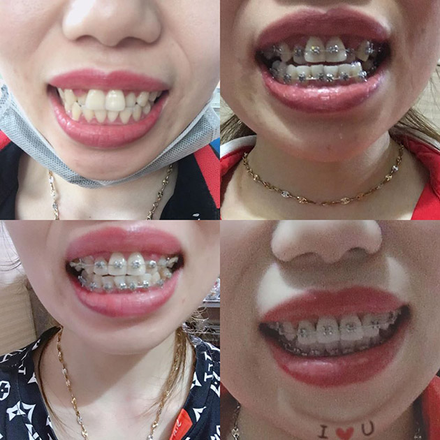 Hình ảnh trước và sau khi niềng răng cực đẹp