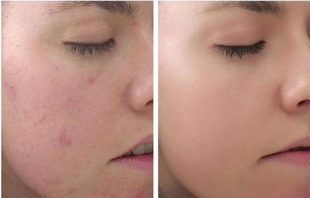 50 hình ảnh peel da đẹp cho các chị em