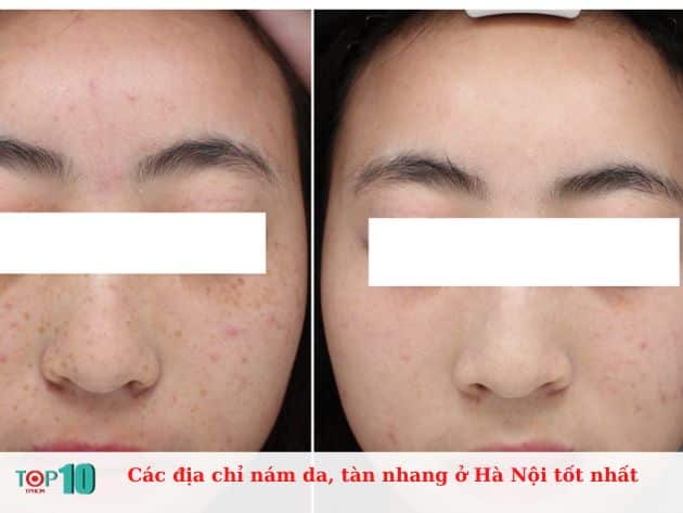 Top 15 địa Chỉ Trị Nám Da Tàn Nhang ở Hà Hội Uy Tín Hiệu Quả 4646