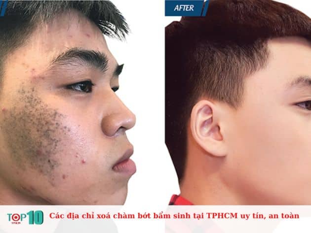 Các địa chỉ xoá chàm bớt bẩm sinh tại TPHCM uy tín, an toàn