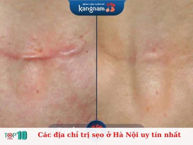 Các địa chỉ trị sẹo ở Hà Nội uy tín nhất