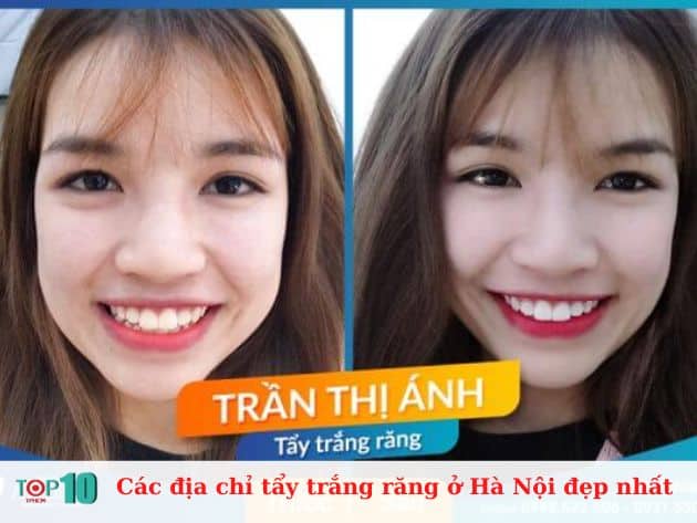 Các địa chỉ tẩy trắng răng ở Hà Nội đẹp nhất