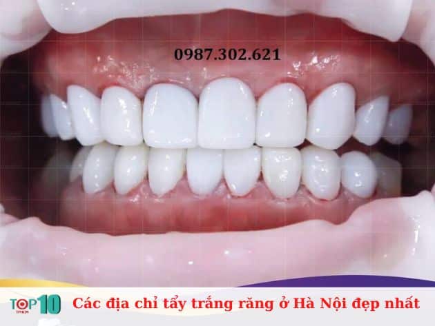 Các địa chỉ tẩy trắng răng ở Hà Nội đẹp nhất