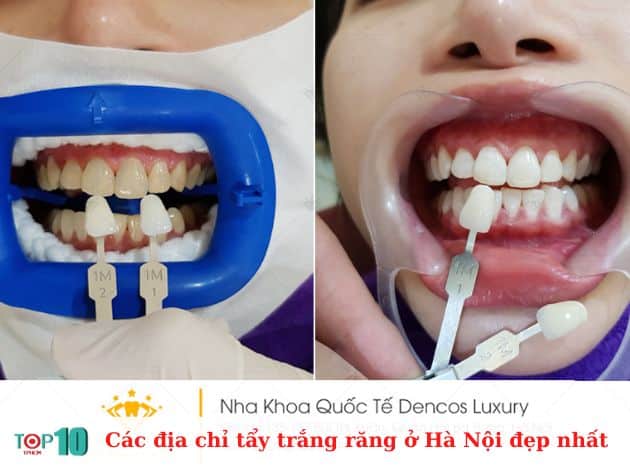 Các địa chỉ tẩy trắng răng ở Hà Nội đẹp nhất