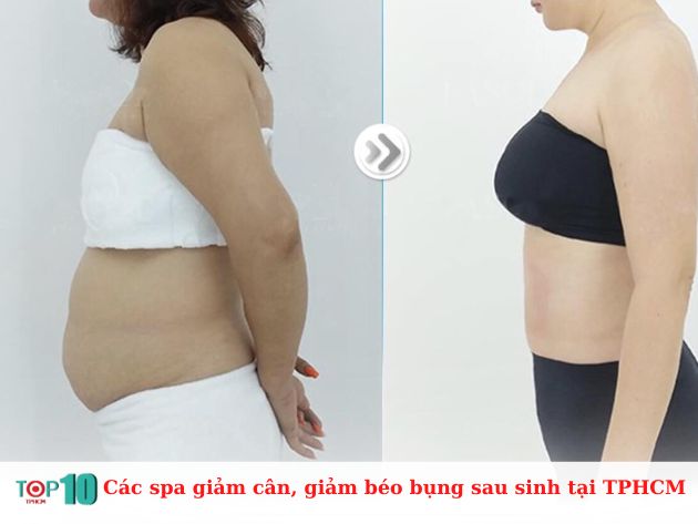  Các spa giảm cân, giảm béo bụng sau sinh tại TPHCM