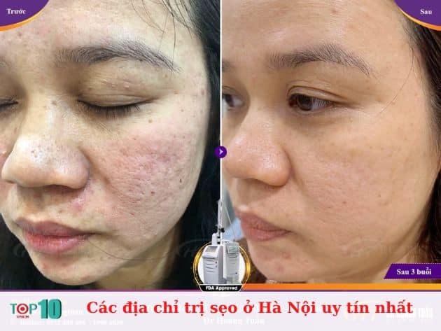 Các địa chỉ trị sẹo ở Hà Nội uy tín nhất