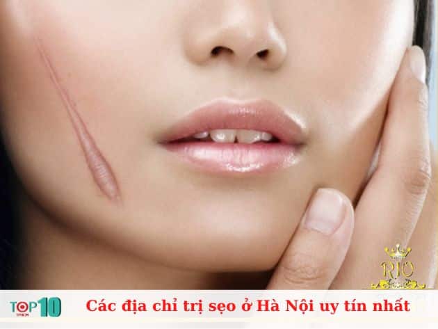 Các địa chỉ trị sẹo ở Hà Nội uy tín nhất