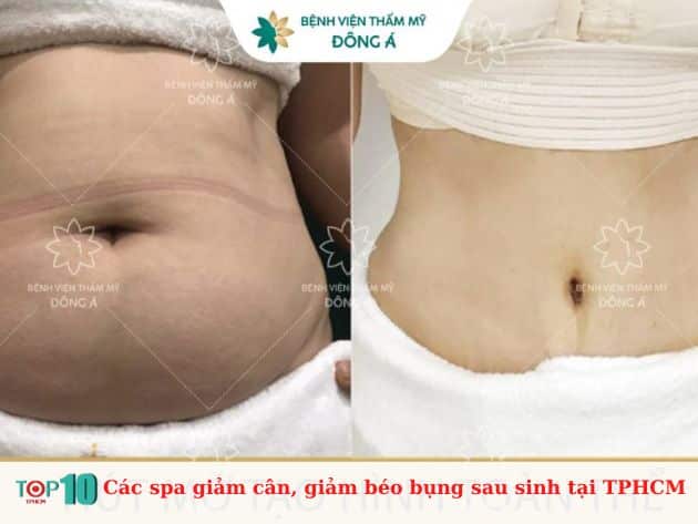  Các spa giảm cân, giảm béo bụng sau sinh tại TPHCM