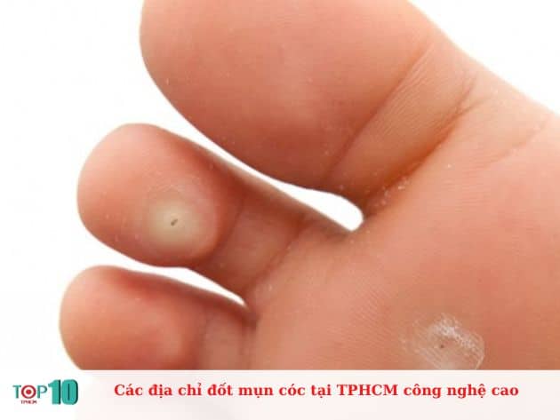 Các địa chỉ đốt mụn cóc tại TPHCM công nghệ cao