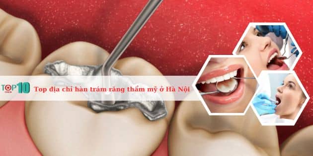 Top các nha khoa hàn trám răng thẩm mỹ ở Hà Nội đẹp, giá tốt