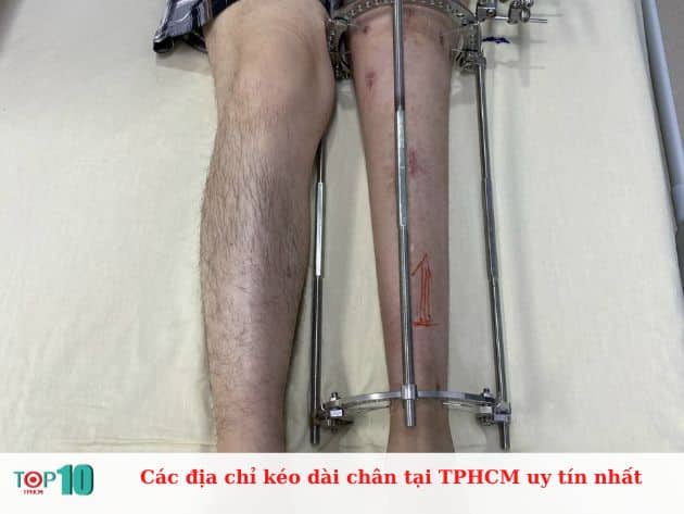 Các địa chỉ kéo dài chân tại TPHCM uy tín nhất