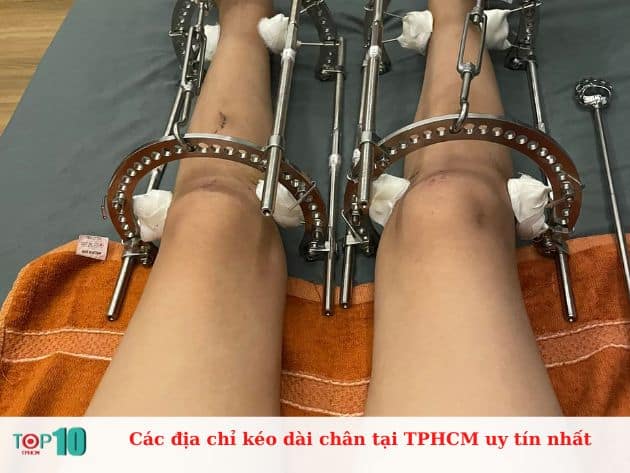 Các địa chỉ kéo dài chân tại TPHCM uy tín nhất