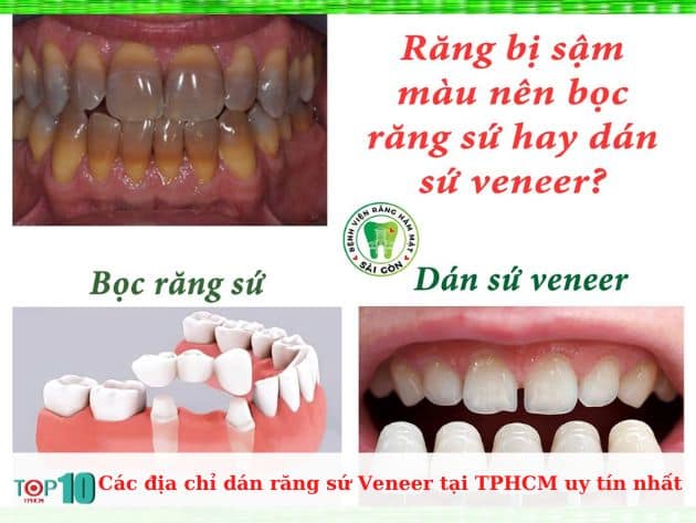 Các địa chỉ dán răng sứ Veneer tại TPHCM uy tín nhất