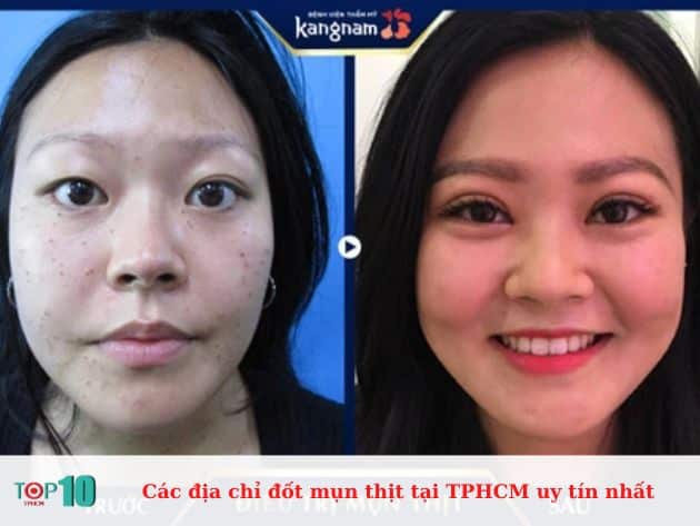 Các địa chỉ đốt mụn thịt tại TPHCM uy tín nhất