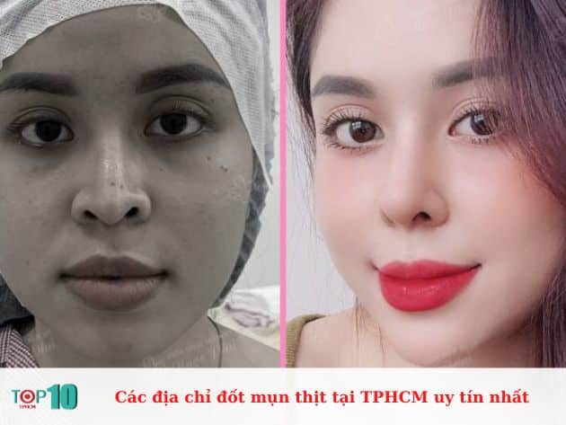 Các địa chỉ đốt mụn thịt tại TPHCM uy tín nhất