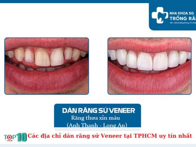 Các địa chỉ dán răng sứ Veneer tại TPHCM uy tín nhất