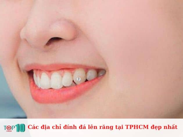 Các địa chỉ đính đá lên răng tại TPHCM đẹp nhất